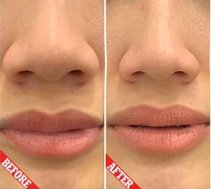 fibroblast lips before and after pic fully healed.