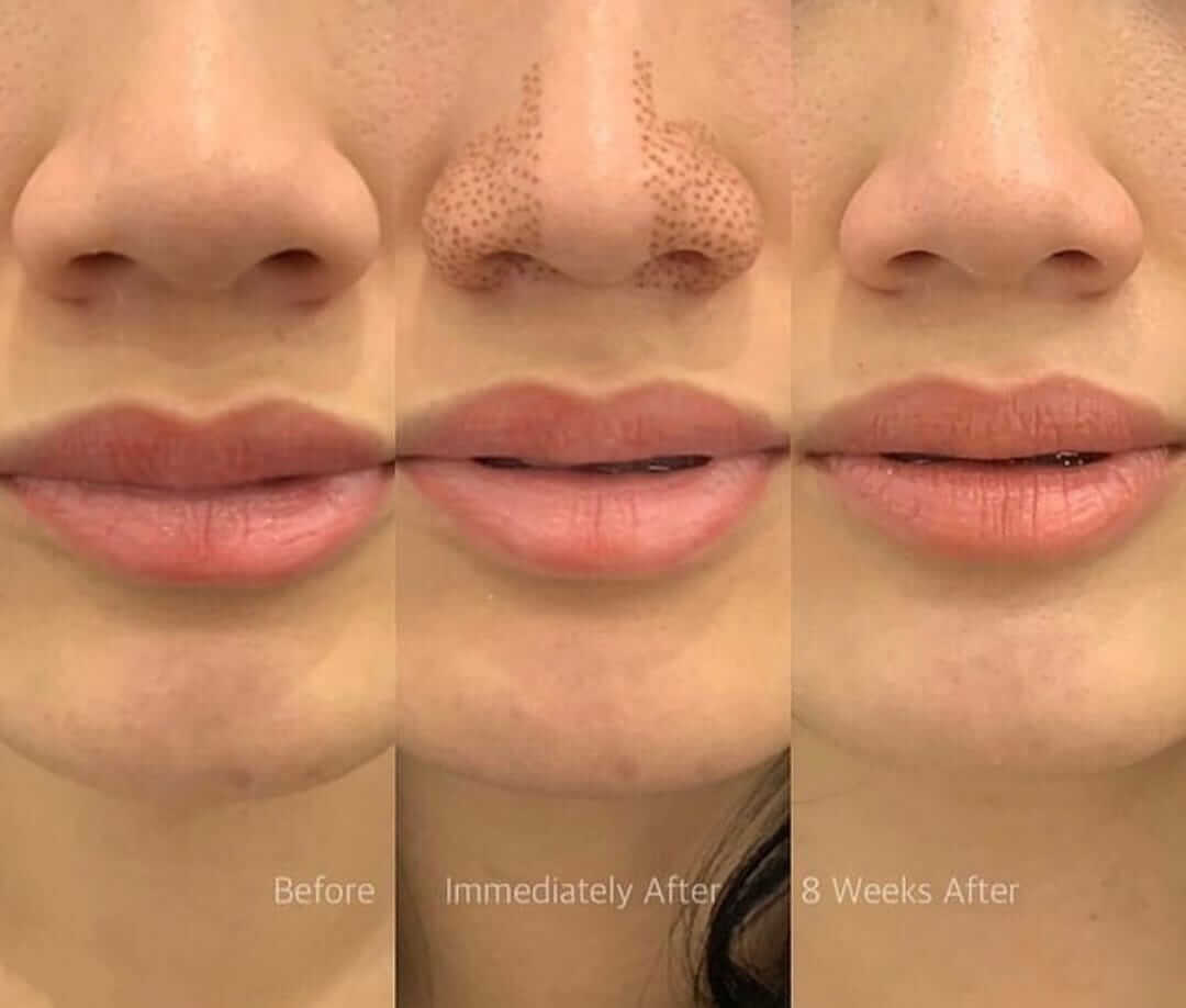 fibroblast -lips before, immediately and 8 weeks after.