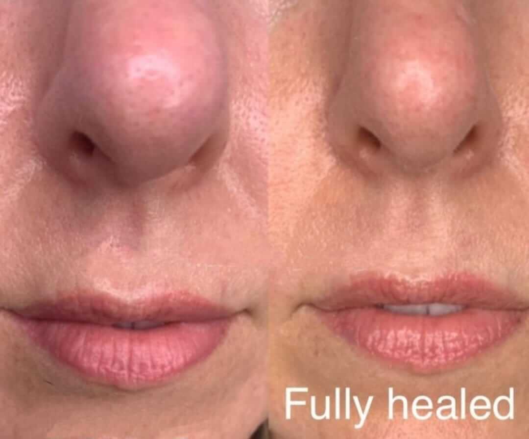 Fibroblast fully healed lips