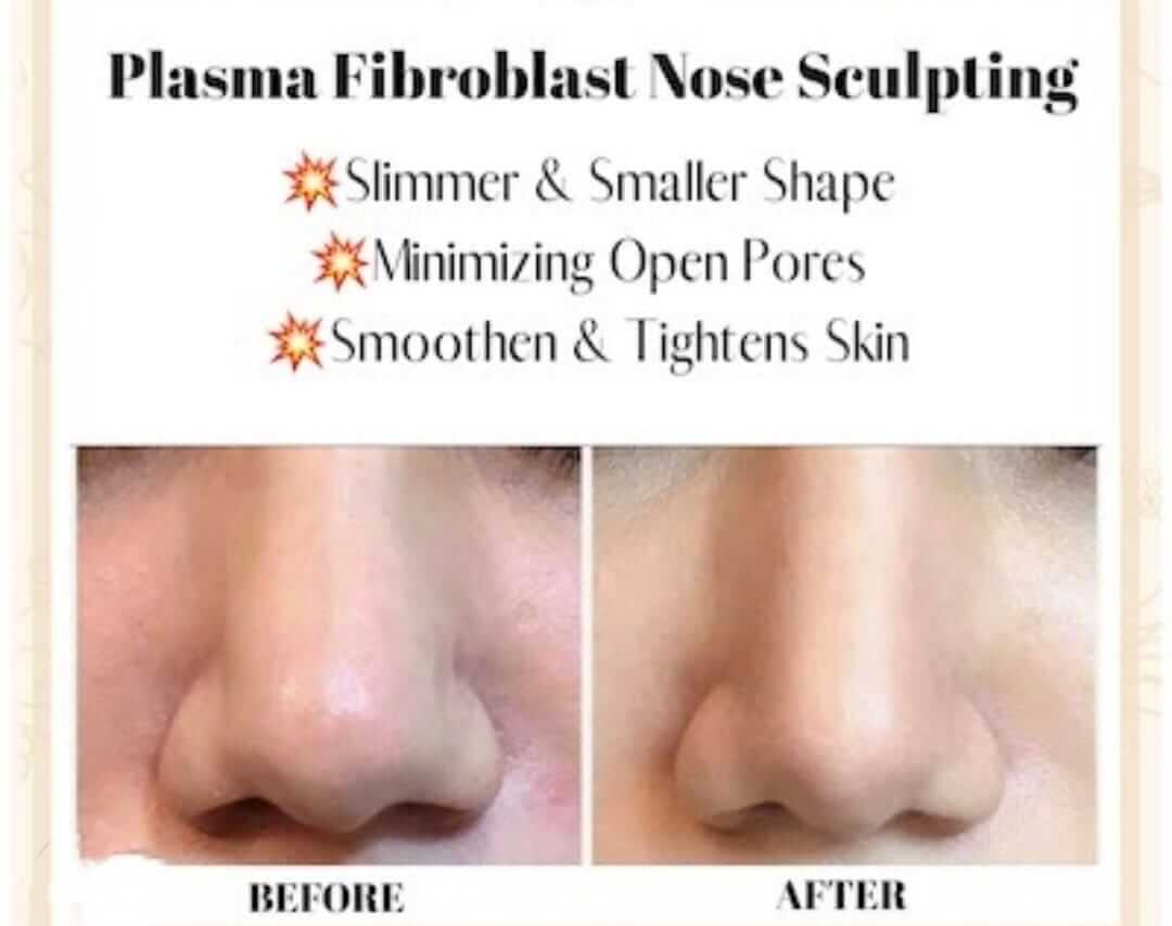 Plasma Fibroblast Nose Sculpting before and after