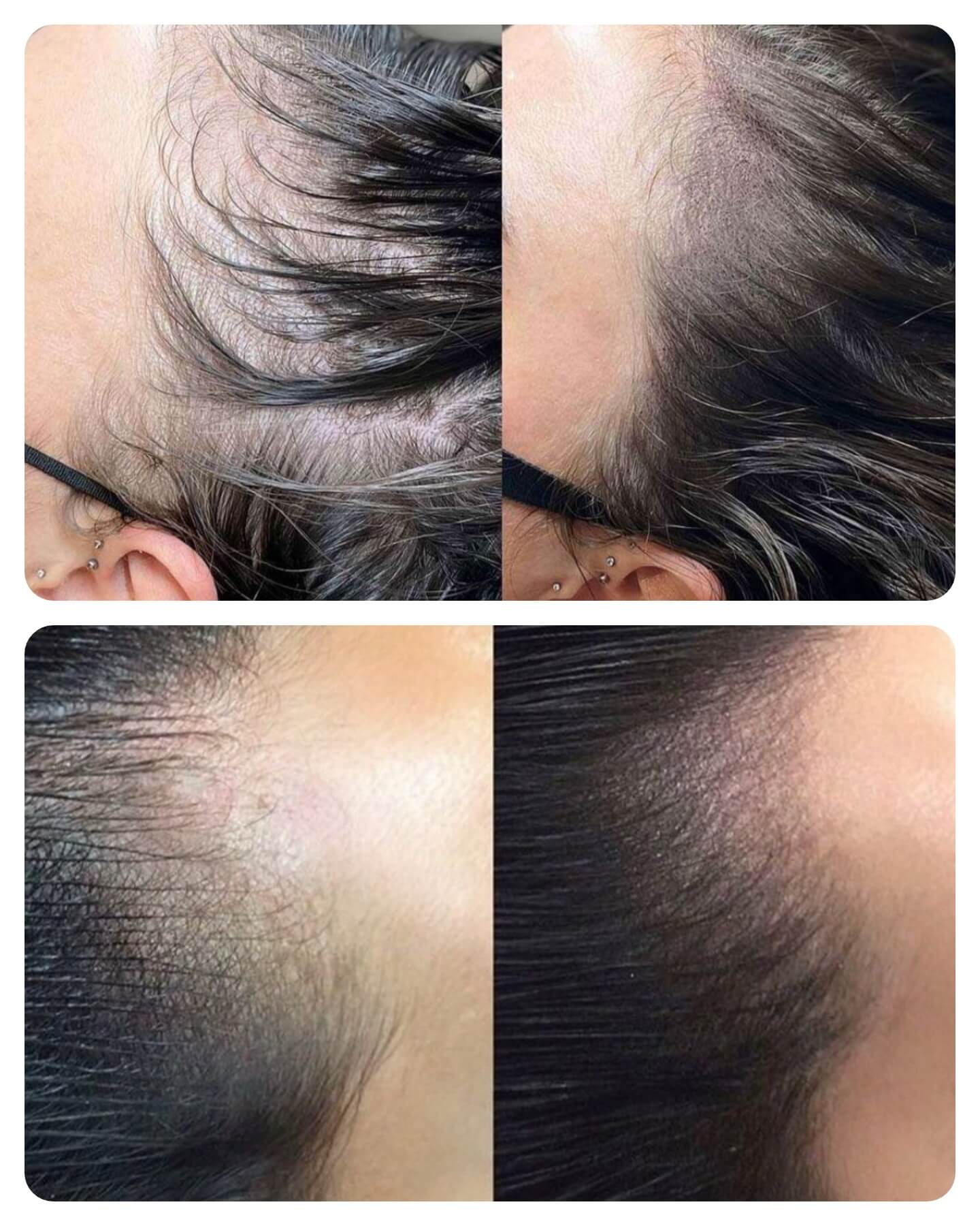 paramedical tattoo image of hairline