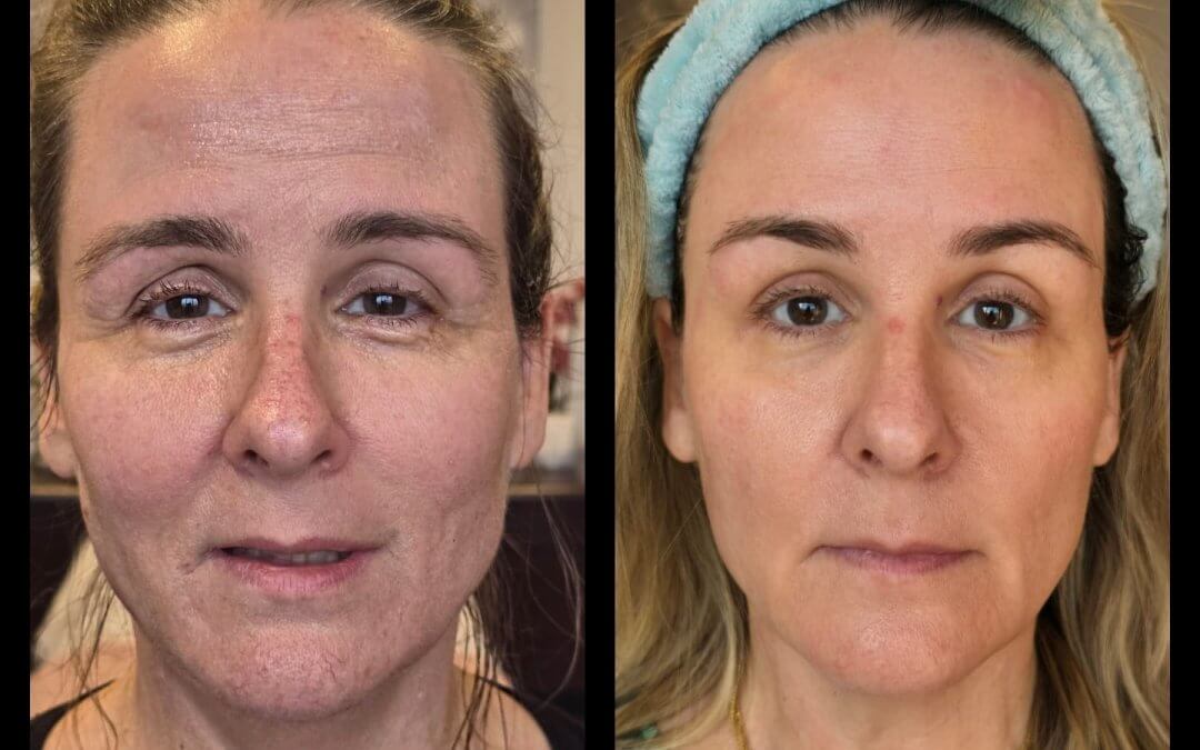 Fibroblast Treatment: A Gentle Approach to Skin Tightening