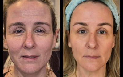 Fibroblast Treatment: A Gentle Approach to Skin Tightening