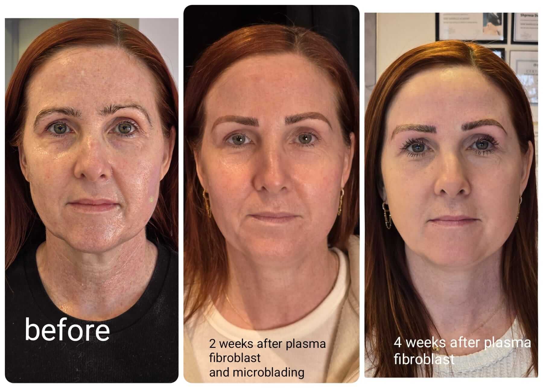 10c87cfa-f7f2-4153-b427-b11d0a3af001 Fibroblast fully healed lips