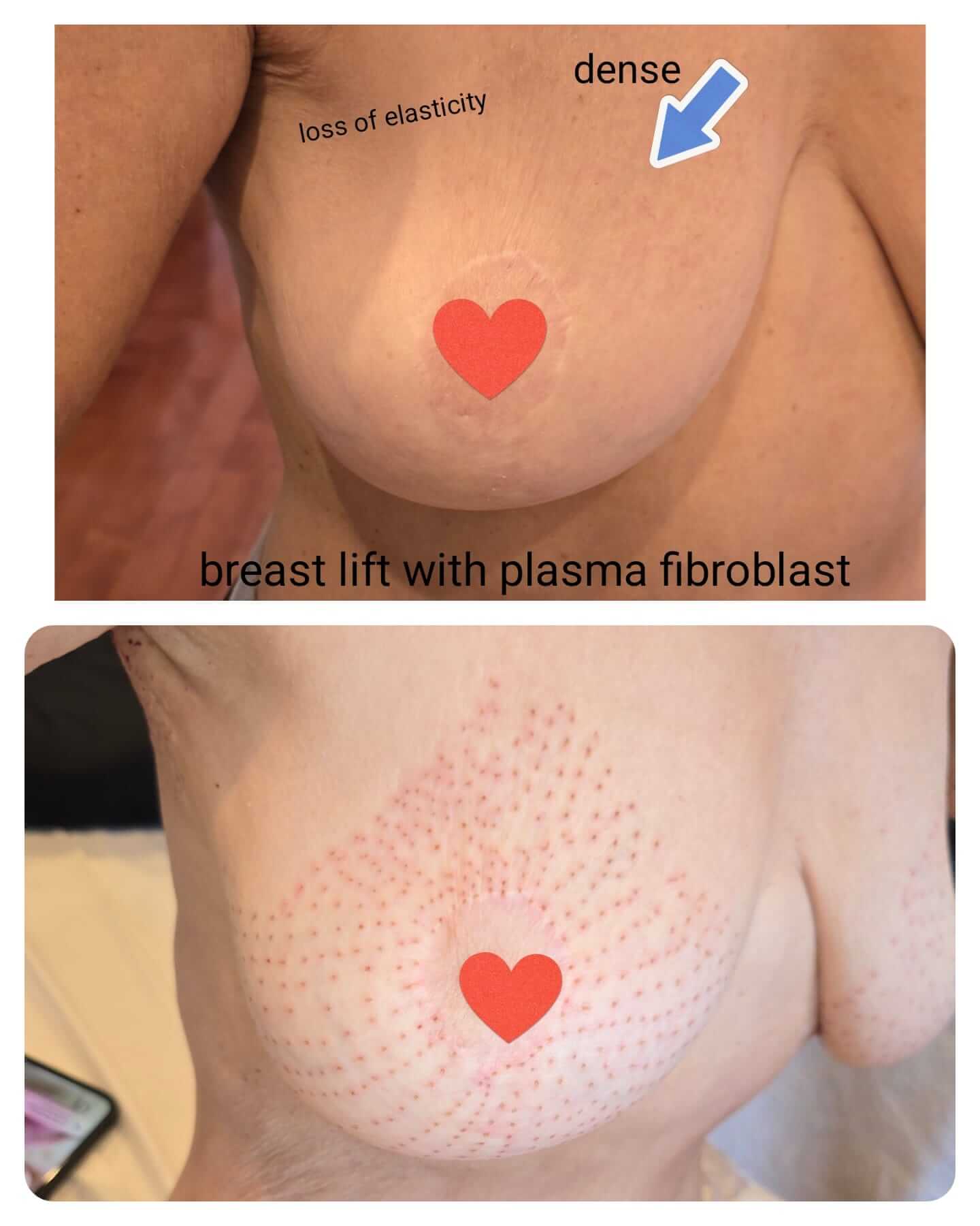 61d116cf-a29f-45ea-b203-b40ccb8b1691 Fibroblast fully healed lips
