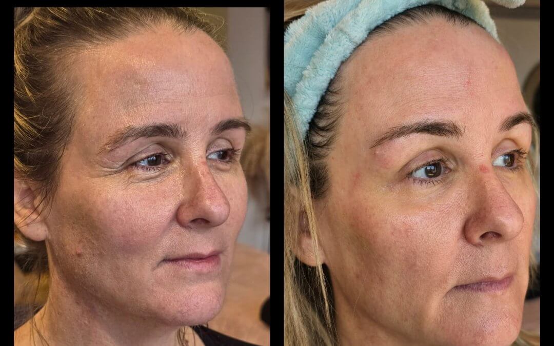 What Plasma Fibroblast Before and After Photos Reveal About Your Skin