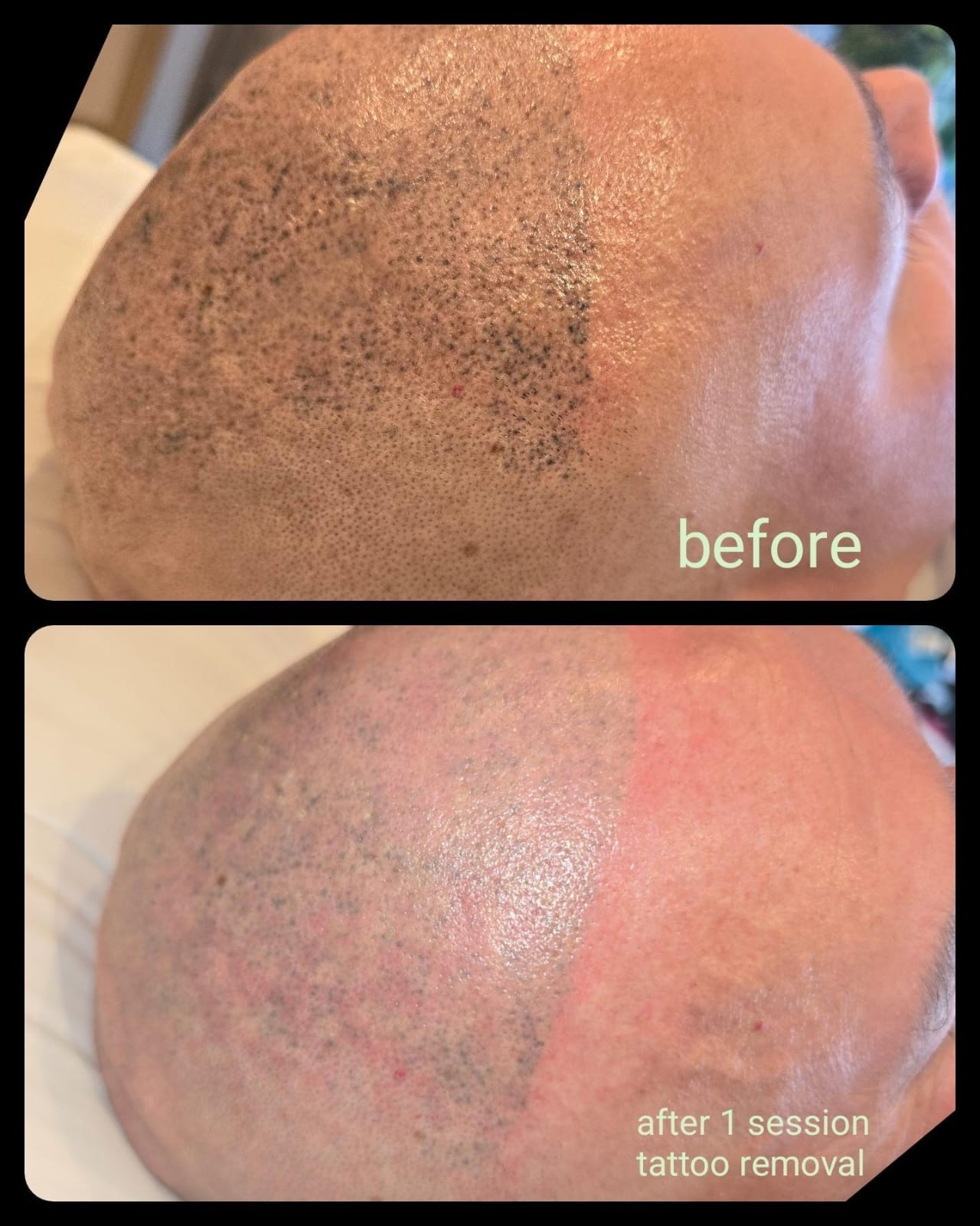 older lady having her tattoo removal