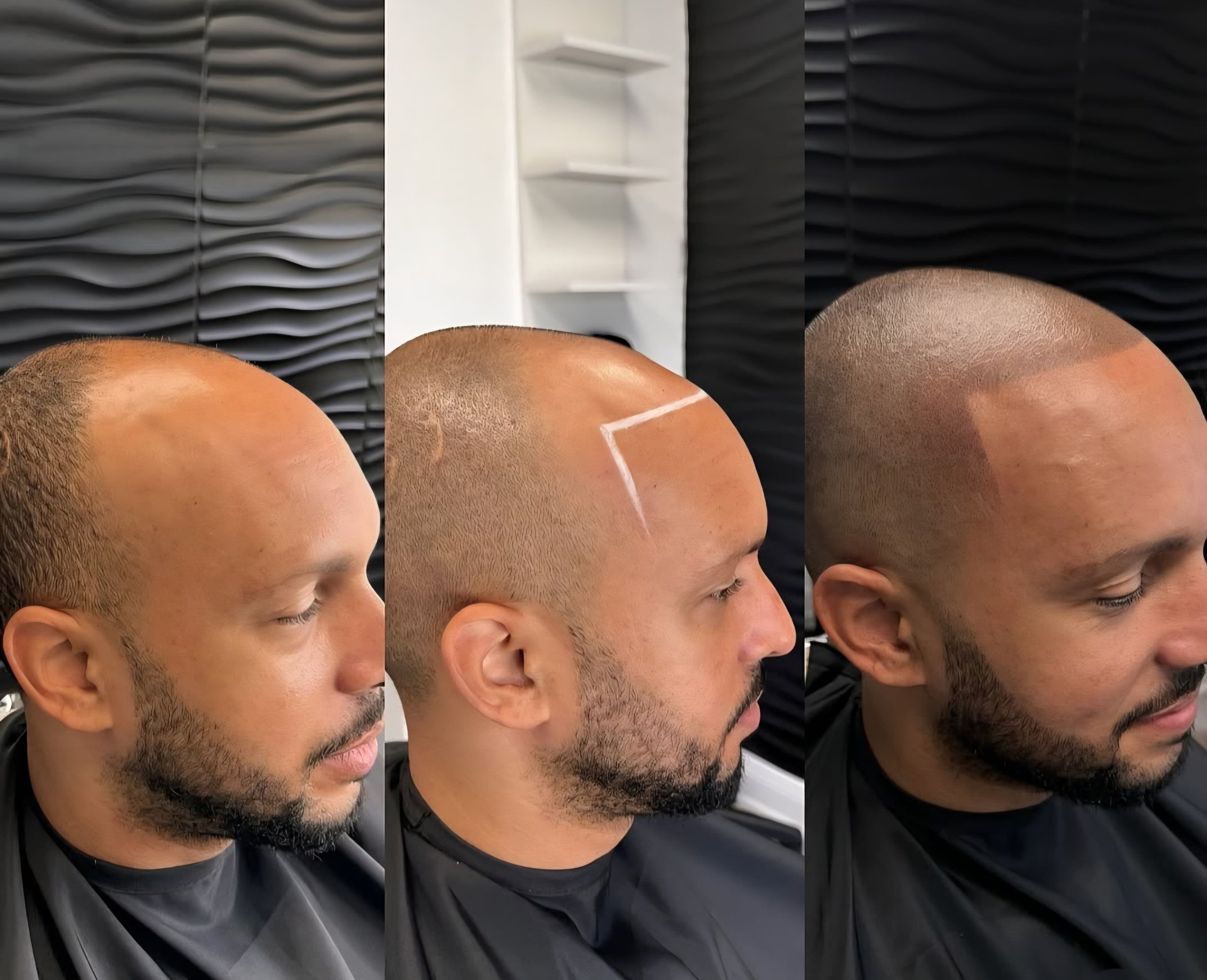 before and after microscalp pigmentation