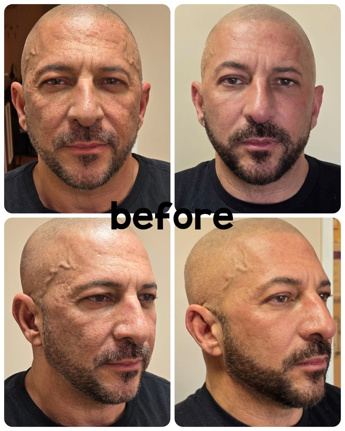 plasma fibroblast - elssa duli