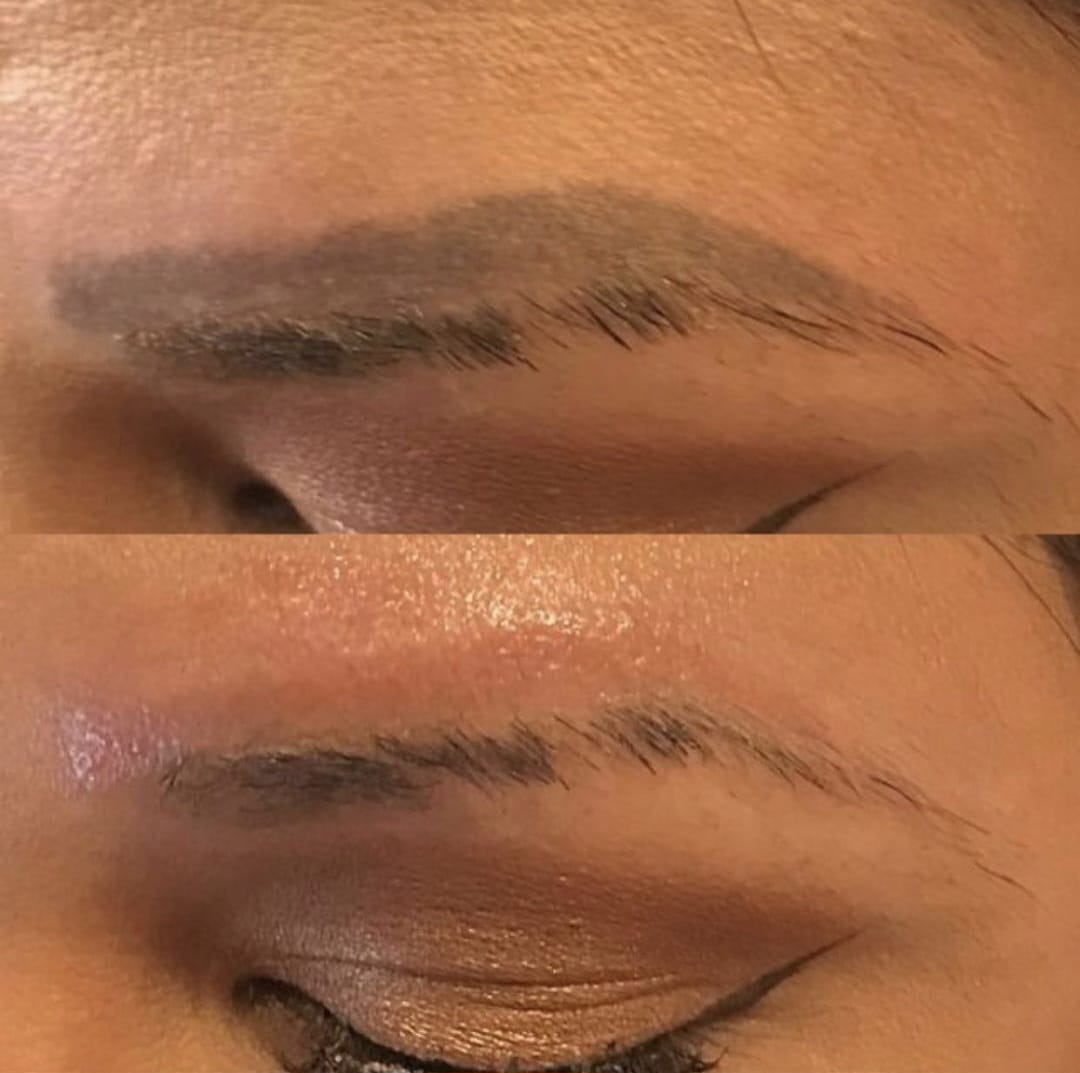 young woman with brow tattoo removal