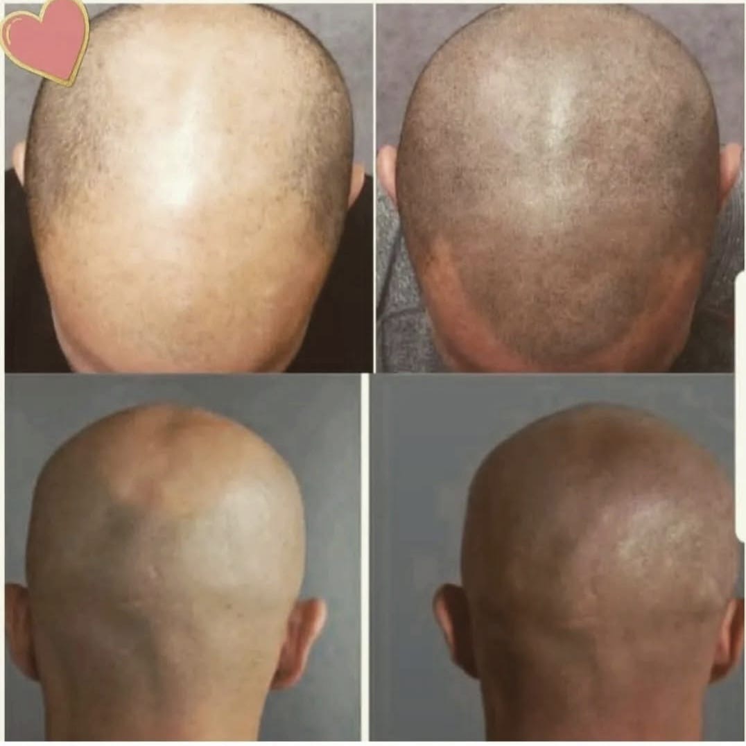 male microscalp pigmentation client