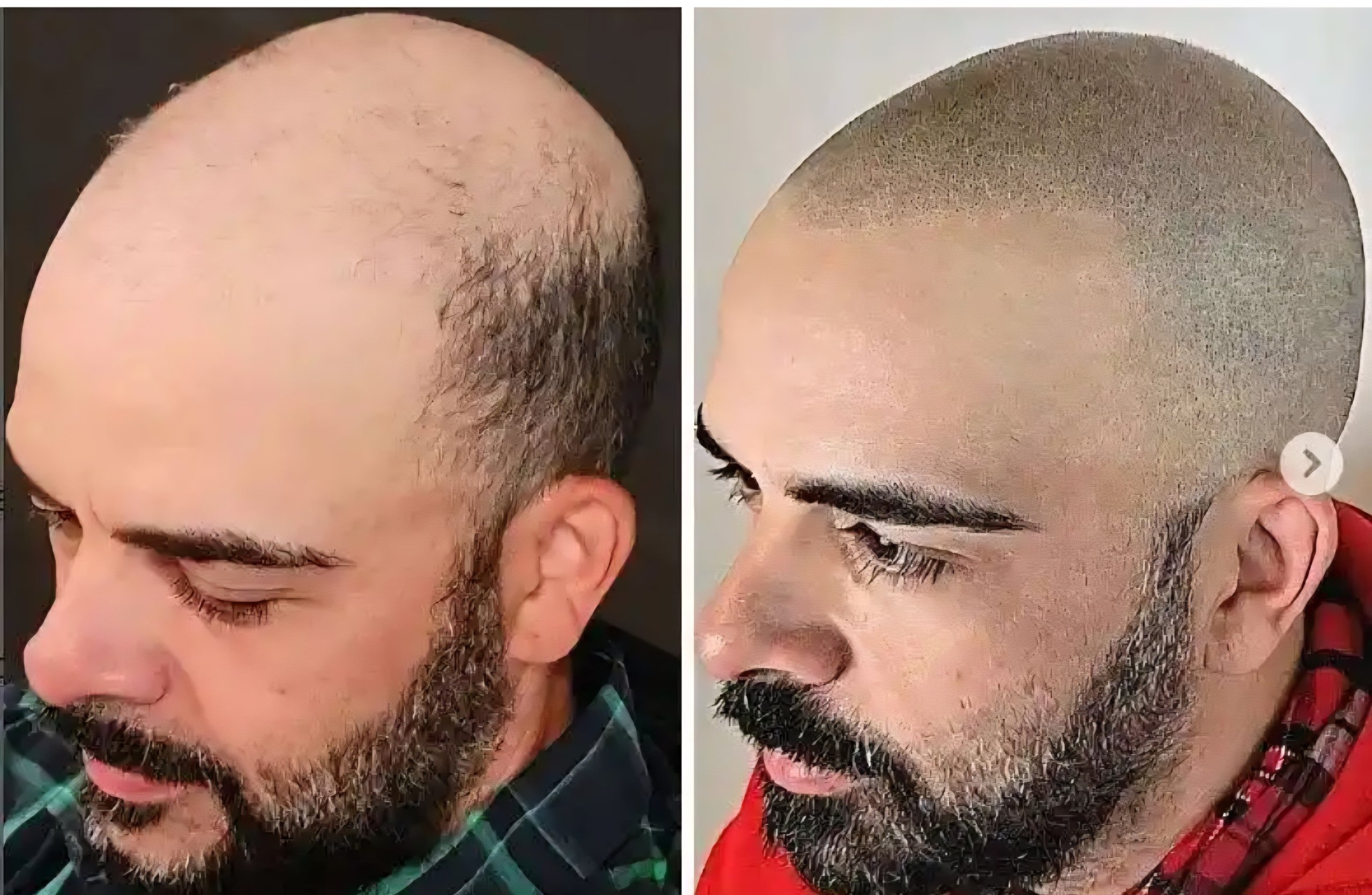 microscalp pigmentation client