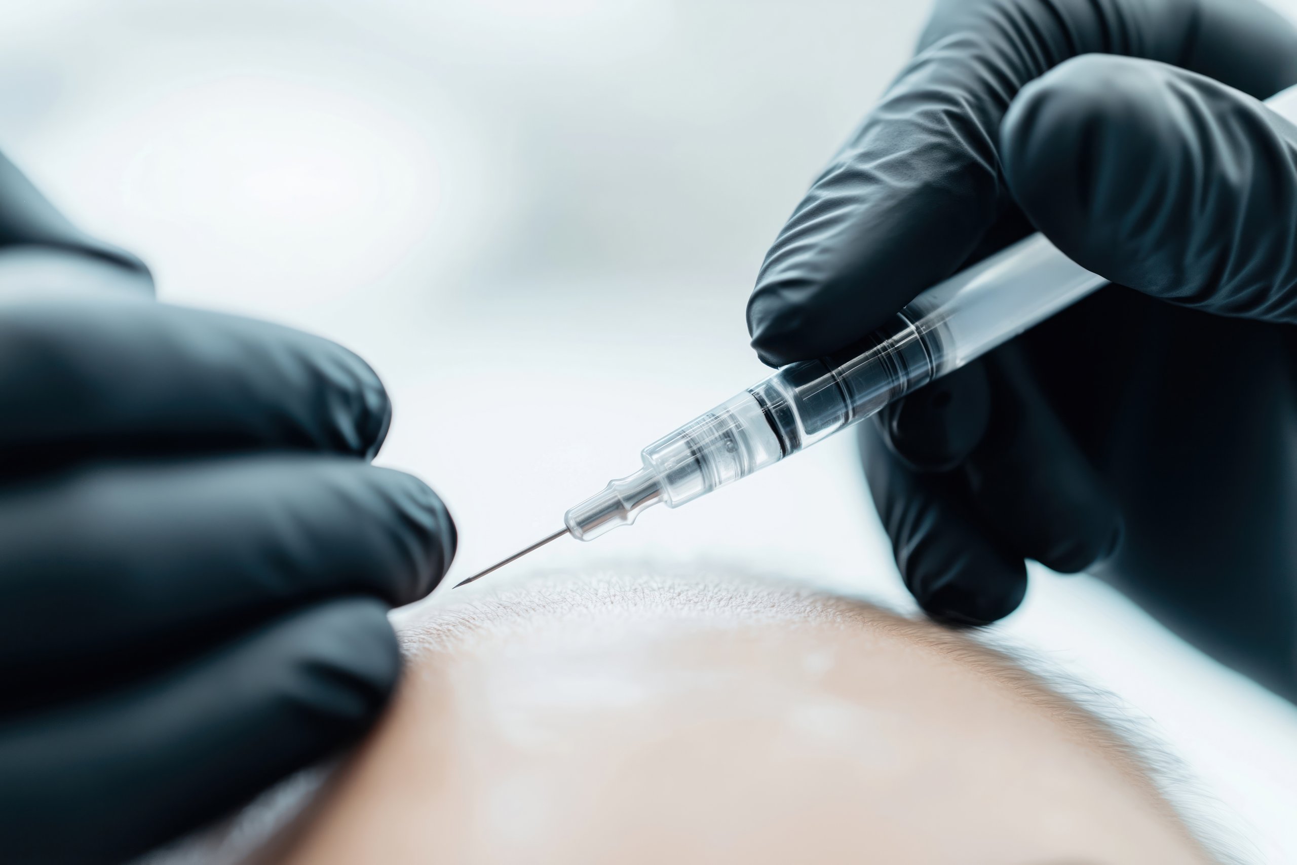 Closeup scalp micropigmentation procedure. Professional in black gloves injects cosmetic solution into scalp. Patient receiving treatment for hair loss. Procedure done in beauty salon clinic. Modern