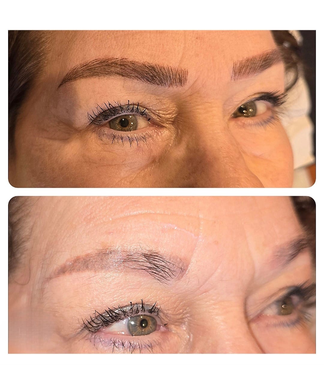 older lady having her tattoo removal