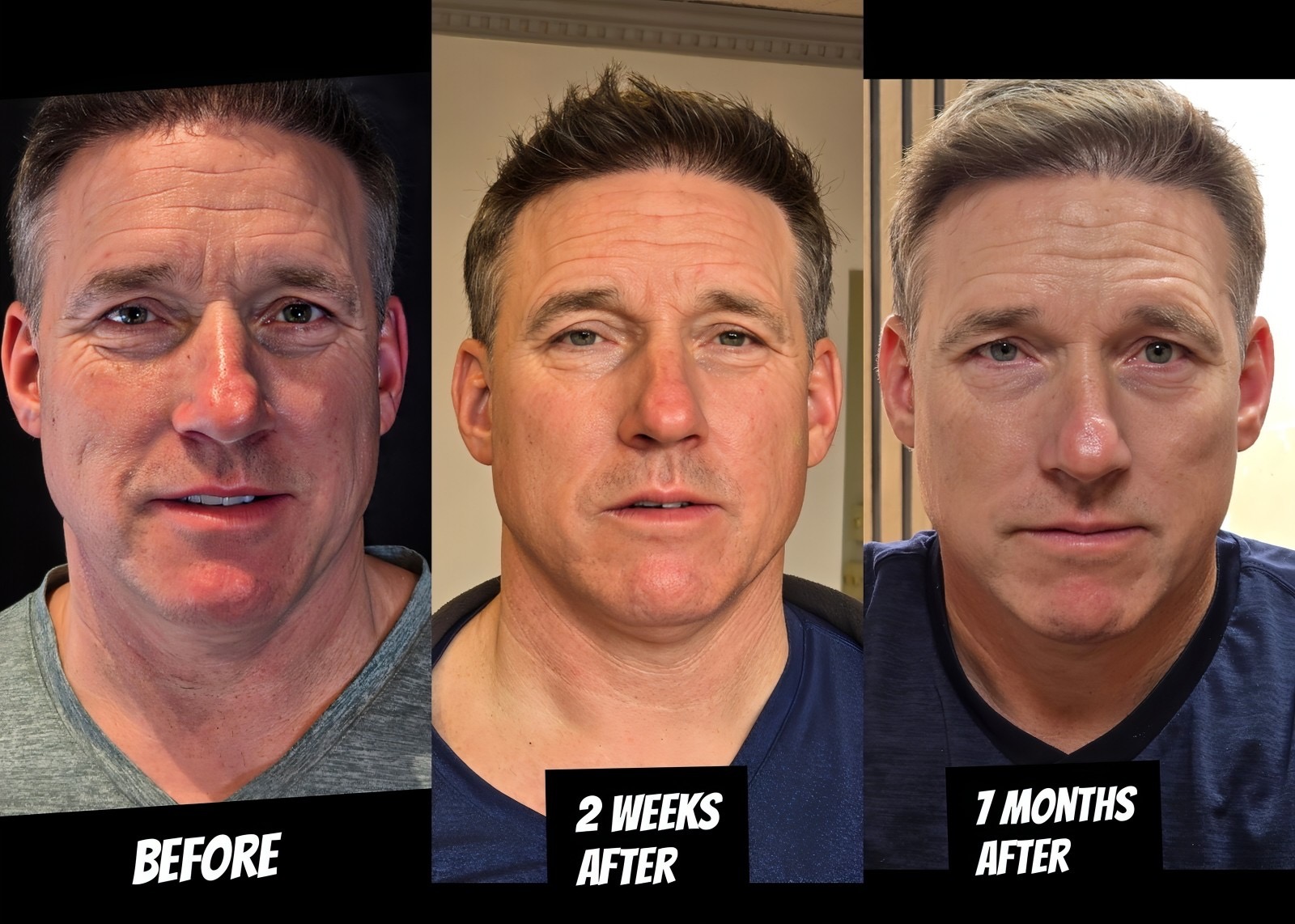 plasma fibroblast - elssa duli - 7 months later