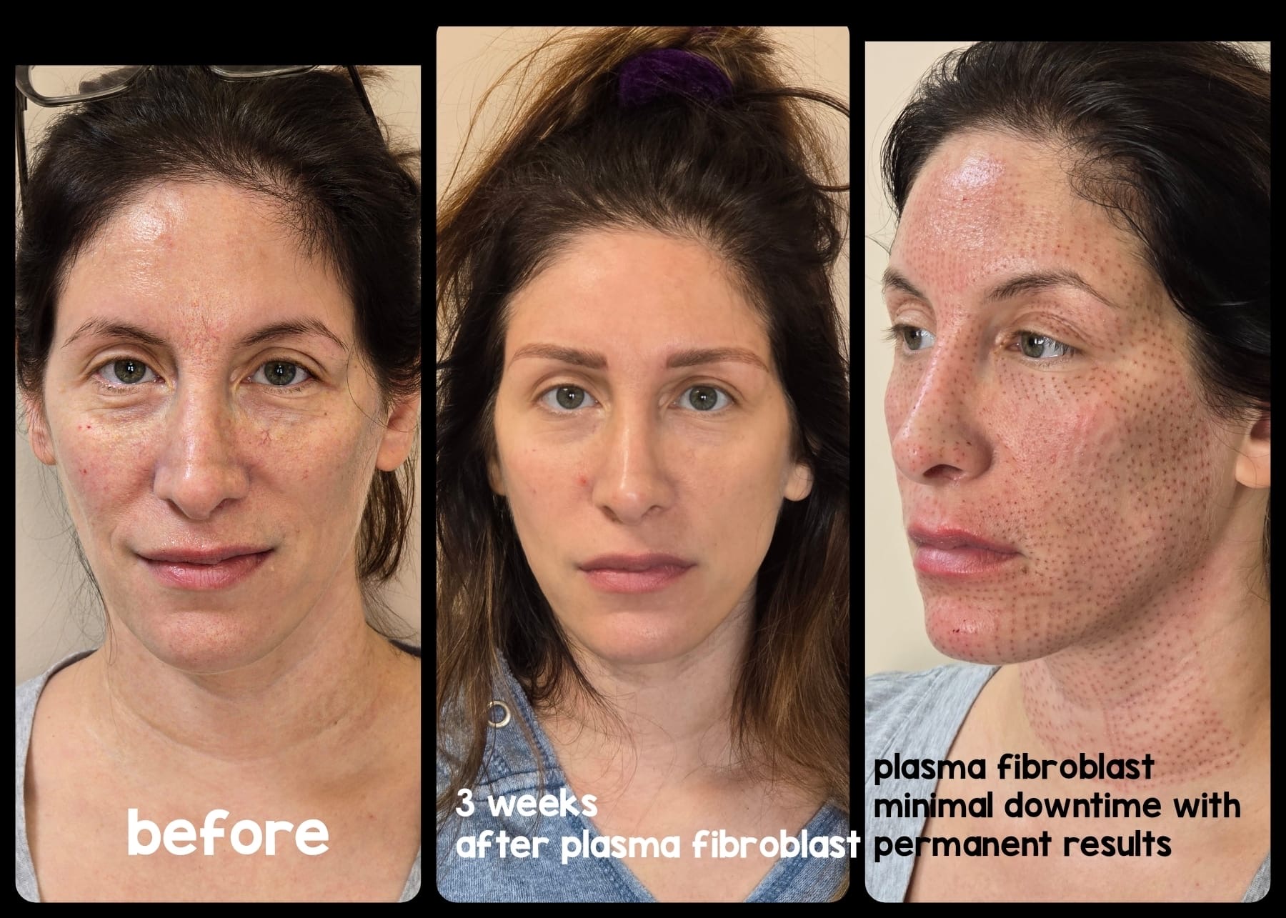 plasma fibroblast - elssa duli